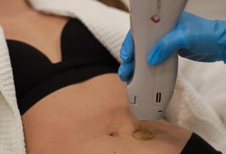 50% скидка на эпиляцию диодным лазером на первое посещение