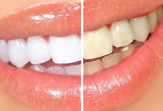 ОТБЕЛИВАНИЕ СИСТЕМОЙ AMAZING WHITE 12 000р. вместо 18 000р.