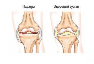 Оздоровительный центр на Соколе: Путь к свободе от подагры
