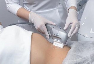 SMAS-лифтинг по телу со скидкой 20%