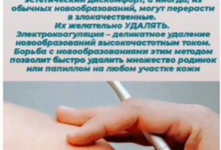 Лазерное удаление папиллом за 400 рублей