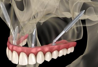 Скуловые импланты Zygoma 195700 руб! м. Белорусская