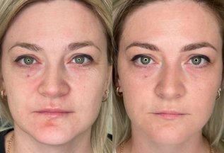 Омоложение FlaxSculpt 3000 руб
