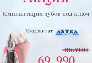 Имплантация зубов под ключ ASTRA