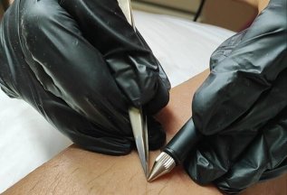 Электроэпиляция
