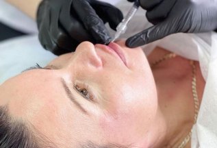 Коррекция губ препаратом гиалуроновой кислоты💉 8000 руб.