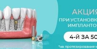 Установи 3 импланта и получи 4-ый по 50% скидке!
