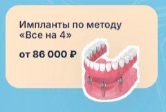 Импланты по методу 