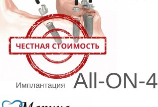 Имплантация ALL-ON-4