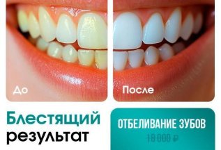 Отбеливание зубов со скидкой 50%