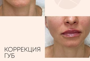 Идеальная коррекция губ Hyon Max 💯