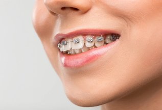 Установка металлических лигатурных брекетов за 29 900 ₽