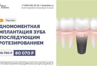 Имплантация зуба с протезированием