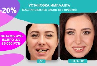 Весенние скидки на стоматологию. Имплантация зубов