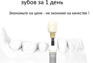 Имплантация зубов с гарантией