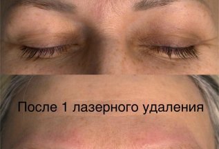 Лазерное удаление перманента 2200 руб