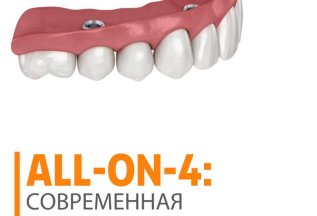 ✨ Подарите себе идеальную улыбку с технологией All-on-4 ✨