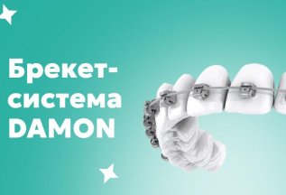Брекет-система DAMON на одну челюсть