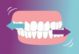 Лечение бруксизма в Best clinic в Краснодаре