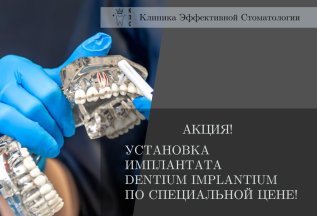 Установка имплантата со скидкой