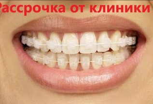 Керамические брекеты под ключ- Рассрочка от клиники