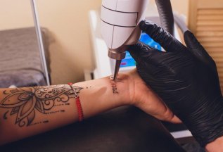 Скидка на первый сеанс при удалении татуировки