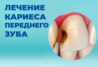 Лечение кариеса со скидкой 50%