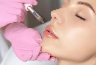 Контурная пластика губ препаратом Belotero Lips Contour