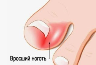 Вросший ноготь