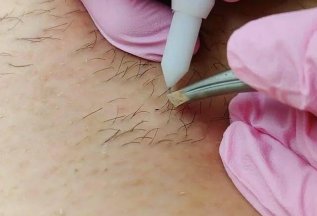 Электроэпиляция-20% на первый визит