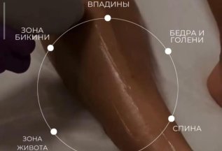Лазерная эпиляция