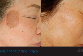 Фототерапия BBL – убрать пигментацию со скидкой 20%