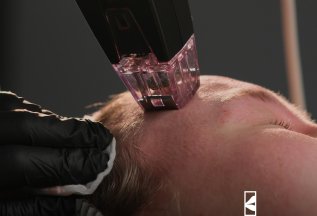 Микроигольчатый RF- лифтинг Morpheus 8 (нижняя треть лица)