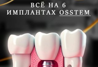 Всё на 6 - х имплантах Osstem