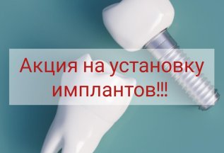 Акционное предложение на имплантацию зубов