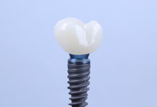 Имплантация Straumann под ключ с циркониевой коронкой