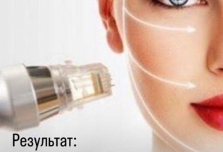 Акция! Микроигольчатый RF-лифтинг