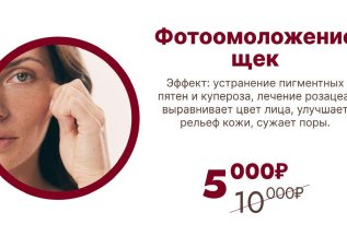 Фотоомоложение щек