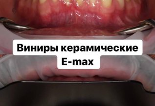 Керамические виниры E-MAX от немецкой компании Ivoclar