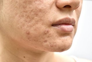 Лазерная шлифовка лица эрбиевым лазером ASCLEPION DERMABLATE