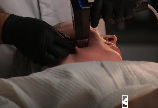 Микроигольчатый RF- лифтинг Morpheus 8 (лицо и шея)