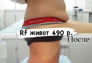 Рф лифтинг тело 490 р.