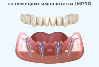 Акция все на 4 на немецких имплантатах IMPRO за 219000 руб.