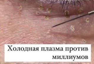 Подарок к обработке лица и тела Холодной Плазмой!