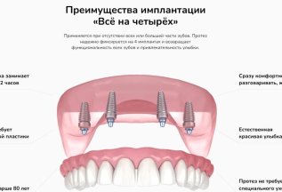 Имплантация «Всё на четырёх» — новая улыбка за 358 800 ₽