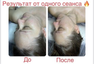 На 5ый пилинг скидка 20%