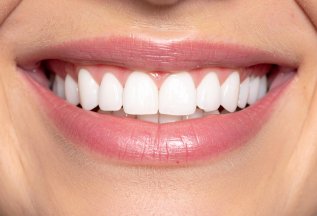 Дарим 50000 на элайнеры + бесплатная консультация