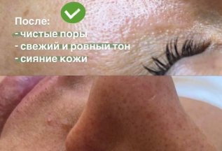 «Комплексное омоложение + очищение + антипигмент»