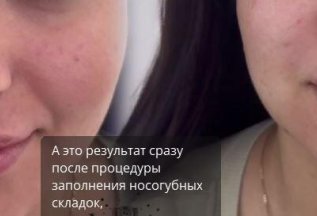 Результат после процедуры заполнения носогубных складок