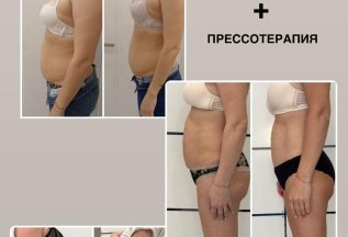 Кавитация + прессотерапия